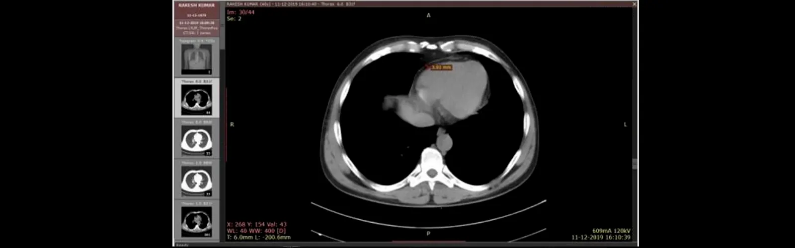 What is the Role of NCCT Chest Scan in the Staging of Cancer?